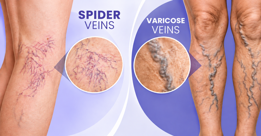 Spider Veins vs Varicose Veins: Key Differences